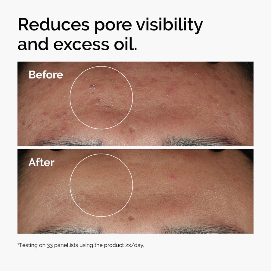 niacinamide-10-zinc-1-j3 ord-niacinamide-zinc-blemish-serum-before-after-pores.jpg