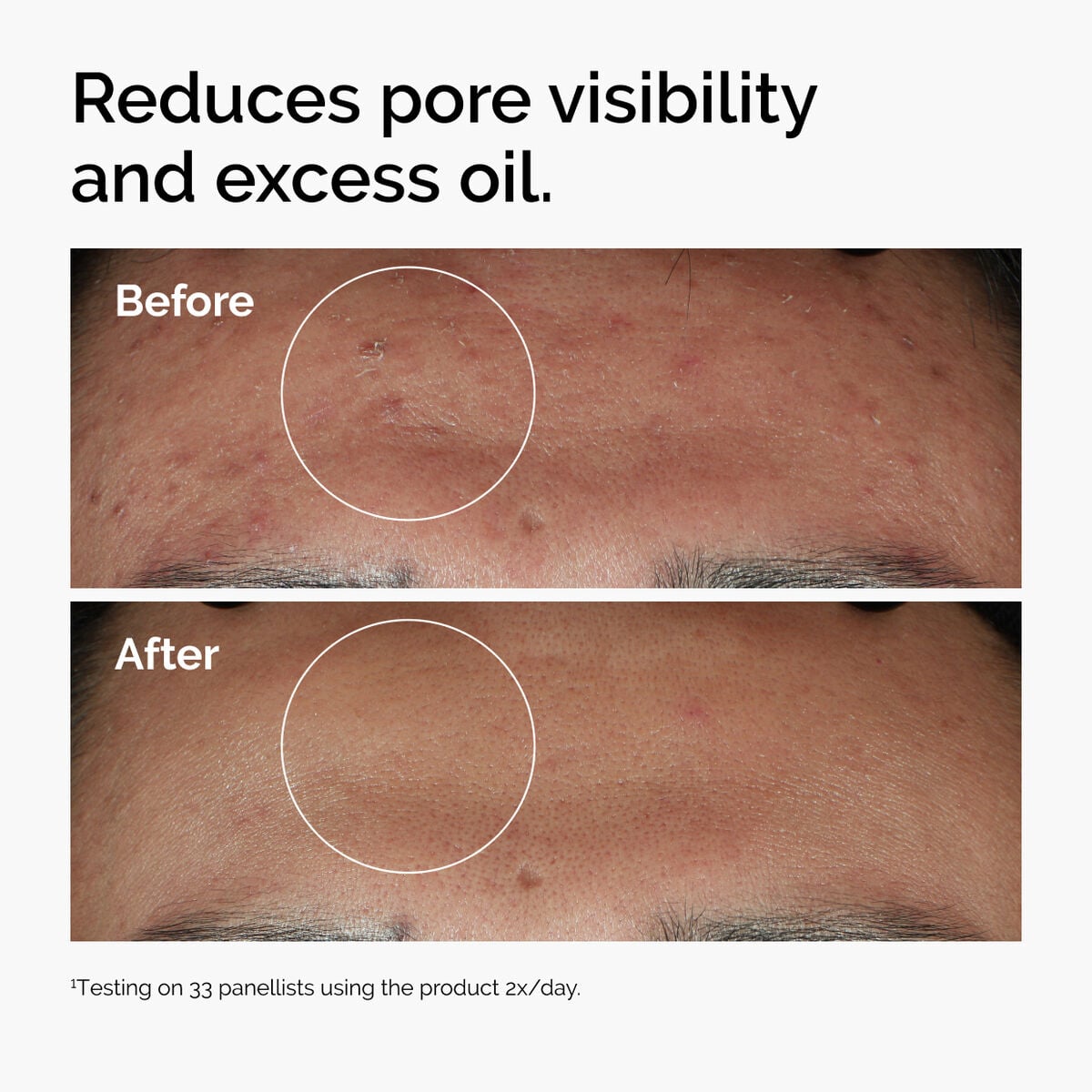 niacinamide-10-zinc-1-j3 ord-niacinamide-zinc-blemish-serum-before-after-pores.jpg