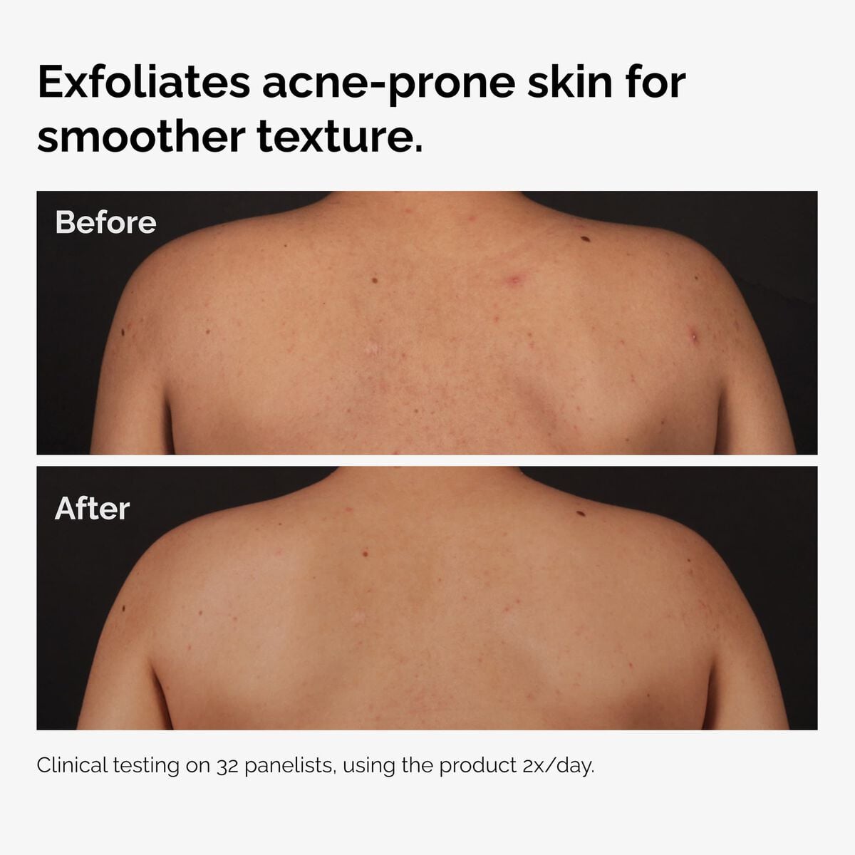 salicylic-acid-0-5-body-serum-y0 ord-salicylic-acid-body-serum-before-after-graphic-NA.jpg