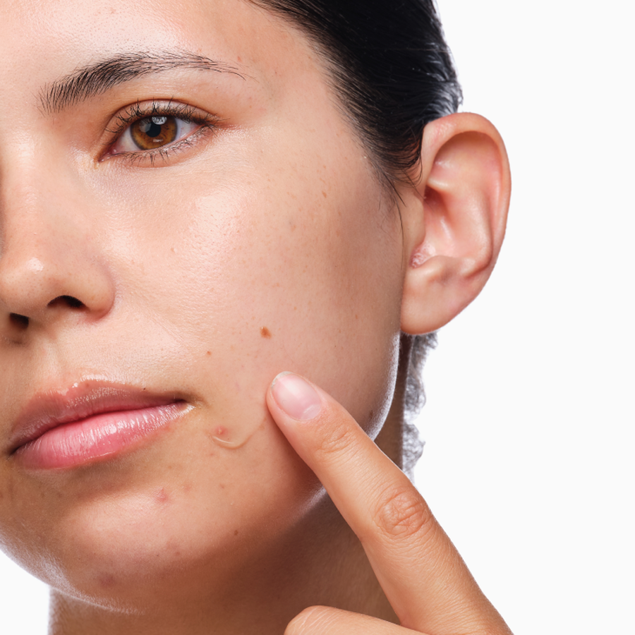the-acne-set-b6 rdn-the-acne-set-application.png